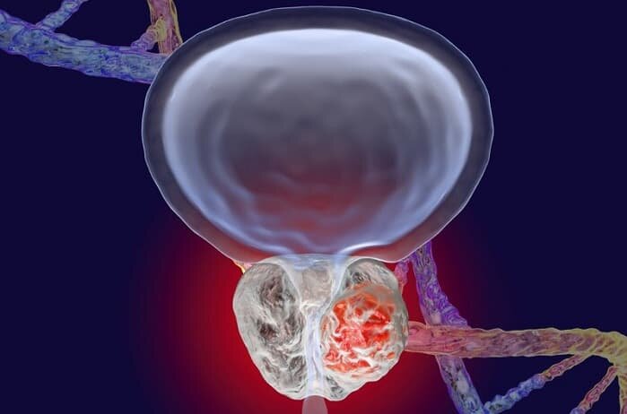 این سرطان مردان به سادگی قابل تشخیص و درمان است