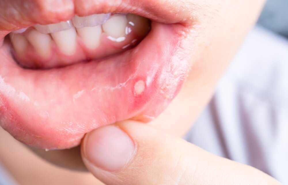 علت آفت زدن دهان چیست؟